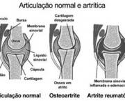 ArtriteIdiopá2.jpg
