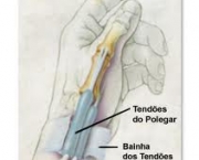 foto-tenossinovite-dequervain-05