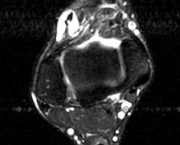 foto-tenossinovite-dos-extensores-dos-dedos-01