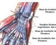 foto-tenossinovite-dos-extensores-dos-dedos-05
