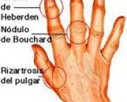 foto-tenossinovite-dos-extensores-dos-dedos-10