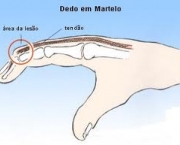 foto-tenossinovite-dos-extensores-dos-dedos-11