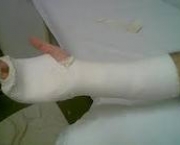 foto-tenossinovite-dos-extensores-dos-dedos-14