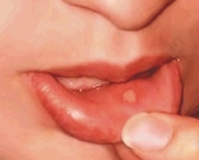 Tipos de Úlcera (6)