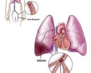 foto-tromboembolismo-pulmonar-03