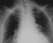 foto-tromboembolismo-pulmonar-07