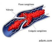 foto-tromboembolismo-pulmonar-11