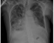 foto-tromboembolismo-pulmonar-12