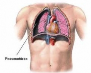 foto-tromboembolismo-pulmonar-14