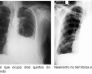 foto-tromboembolismo-pulmonar-15