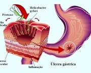 Úlcera de Estômago Pode Virar Câncer (1)