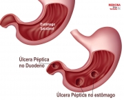Úlcera de Estômago Pode Virar Câncer (2)