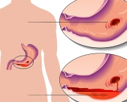 Úlcera de Estômago Pode Virar Câncer (3)