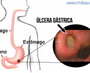Úlcera de Estômago Pode Virar Câncer (12)