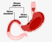 Úlcera Duodenal - Tratamento Natural (13)