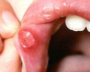 Ulceração (10)