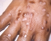 Varíola (2)