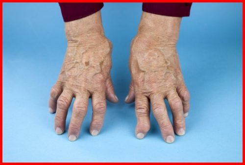 Dedos Tortos Devido à Artrite Reumatoide