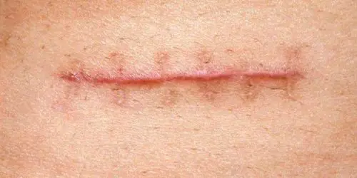 Cicatriz Hipertrófica 