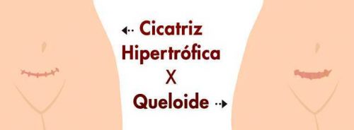 Cicatriz Hipertrófica vs Quelóides