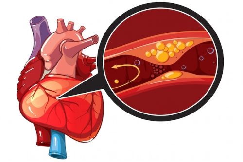 Ilustração de Isquemia Cardíaca 
