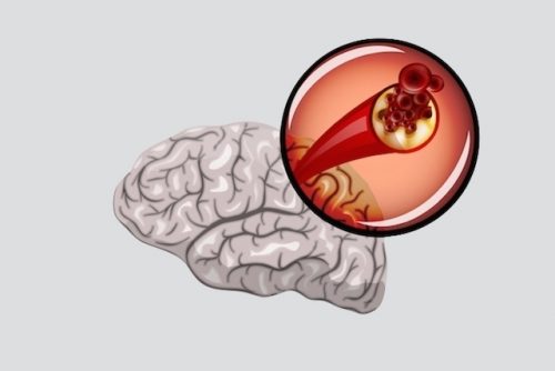 Ilustração de um Tipo de Isquemia - Cerebral 