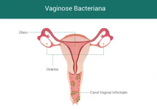 Vaginose Bacteriana