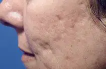 Cicatrizes de Acne