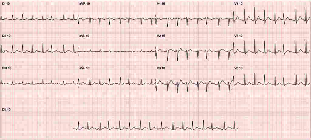 Fibrilação Atrial