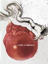 cisto ovariano-1