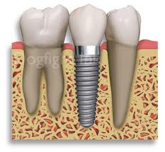 implante dentario-1