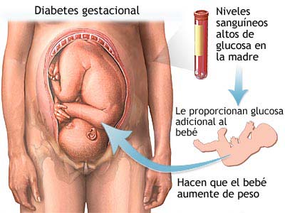 Diabete Gestacional