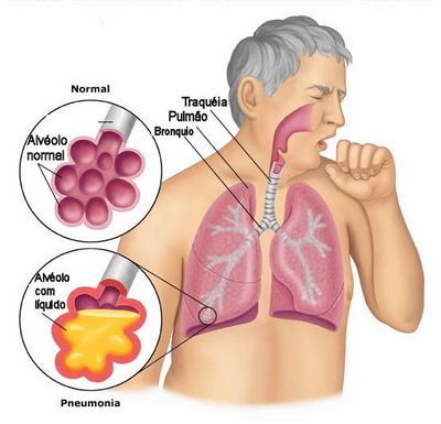 Doença Pneumonia