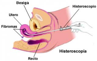 Exame: Histeroscopia