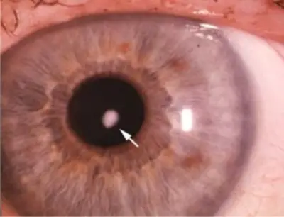 Catarata Ocular