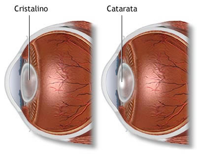 Catarata Ocular
