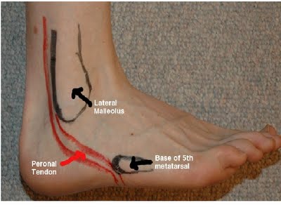 Tendinite Fibular