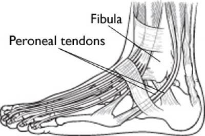 Tendinite Fibular