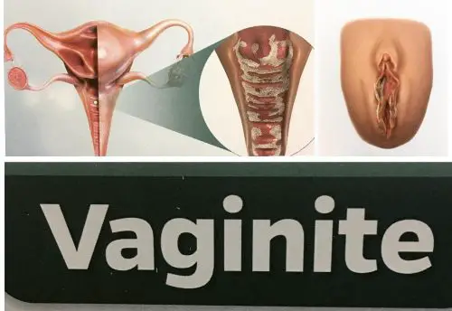 Vaginite 