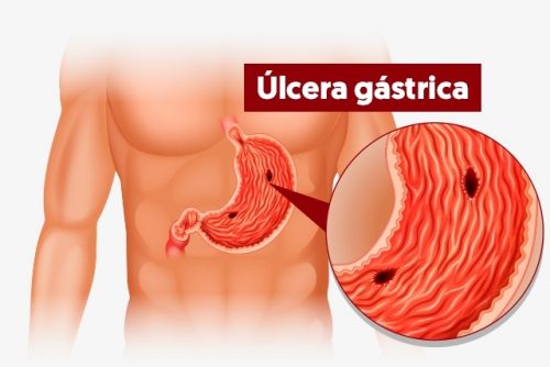 Úlcera Gástrica