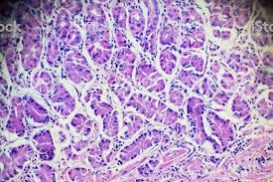 Metaplasia Intestinal