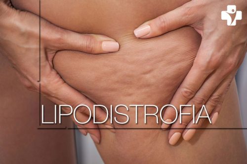 Lipodistrofia