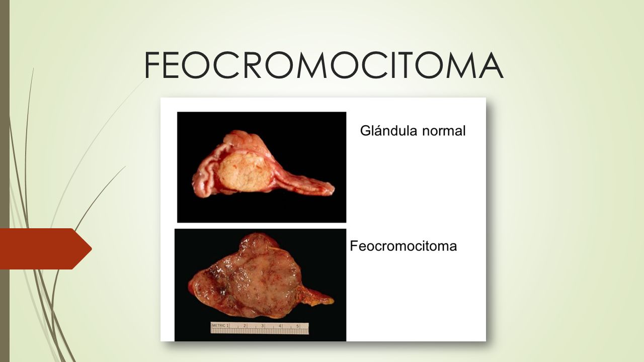 Feocromocitomas