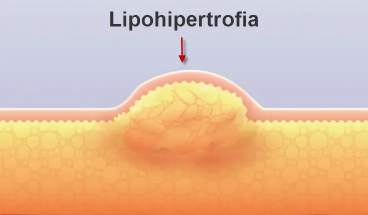 Lipohipertrofia 